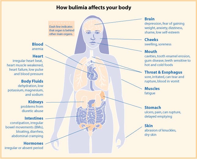 Diagram showing how bulimia affects your body